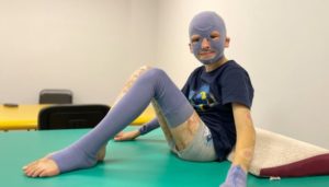 Хлопчик, який вижив після російського ракетного удару у Вінниці, перетерпів 37 операцій у боротьбі за життя